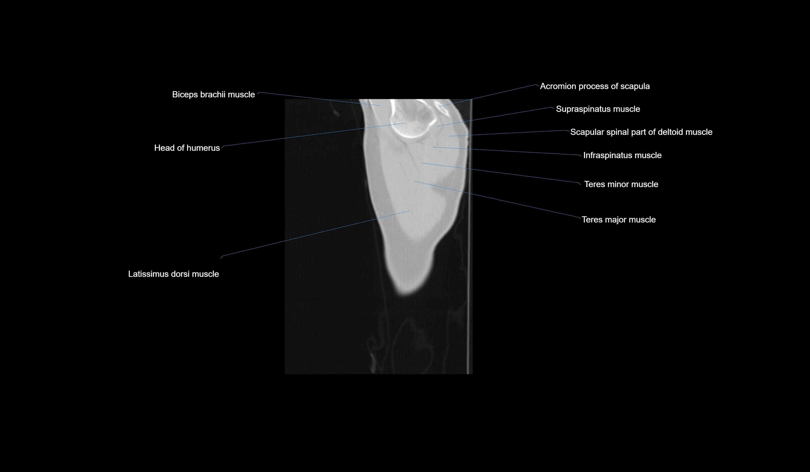 CT chest (thorax) labelled sagittal cross sectional anatomy radiology image-00004.webp